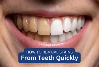 How to Remove Stains From Teeth Quickly?