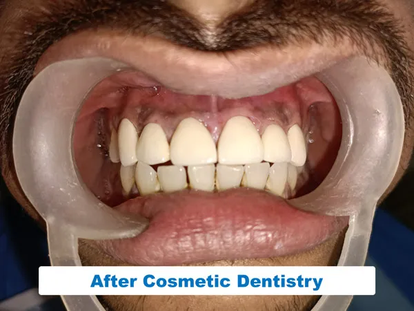 The enhancement in the teeth shape after getting the smile design treatment from the best cosmetic dentist in Kolkata