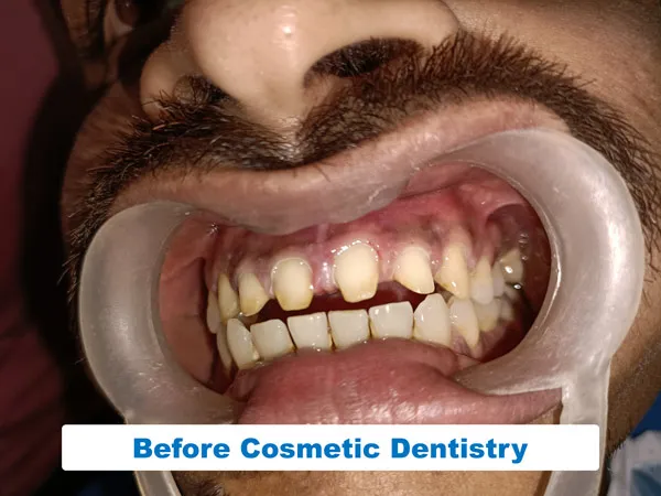 The teeth shape before getting the smile design treatment from the top cosmetic dentist in Kolkata