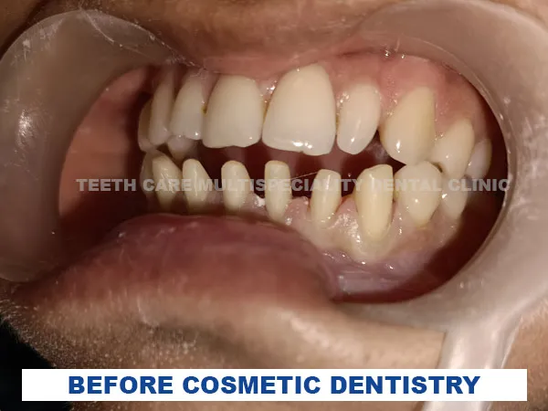 before cosmetic dentistry in kolkata