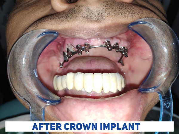 The final crown implant is left after the screw installation at the best dental clinic in Kolkata.