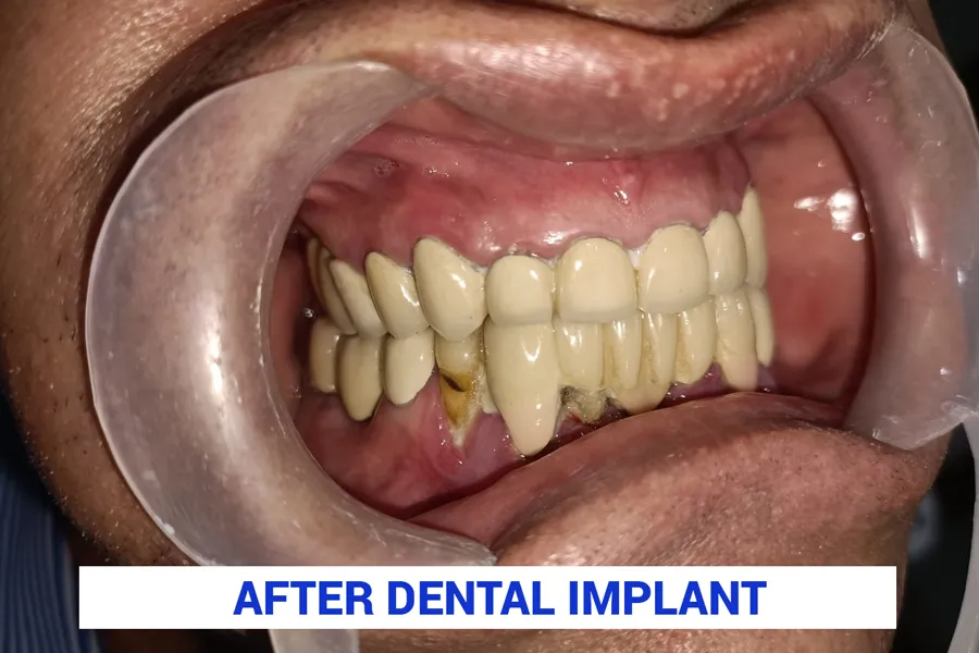 after dental implant in kolkata 