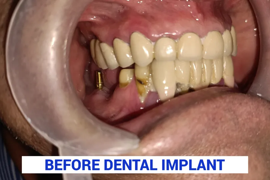 before dental implant in kolkata
