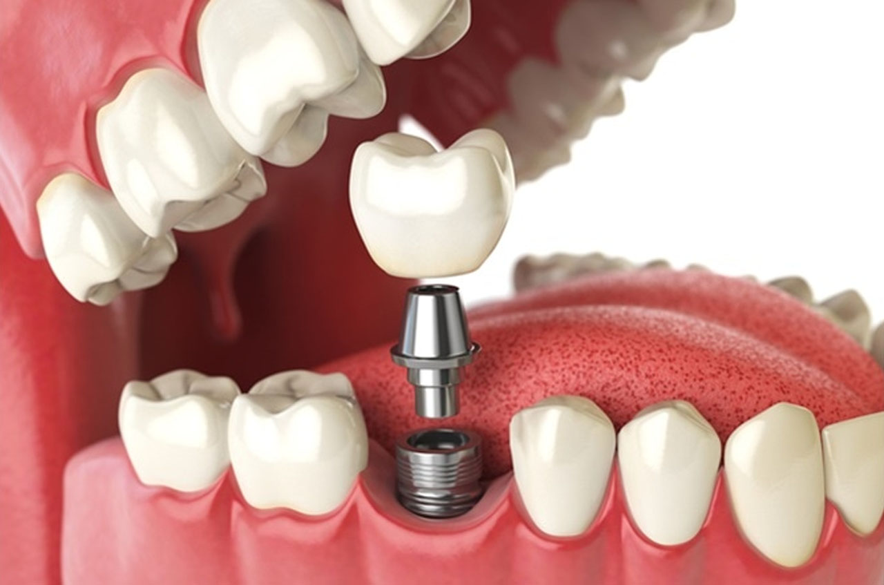 dental implant In Kolkta