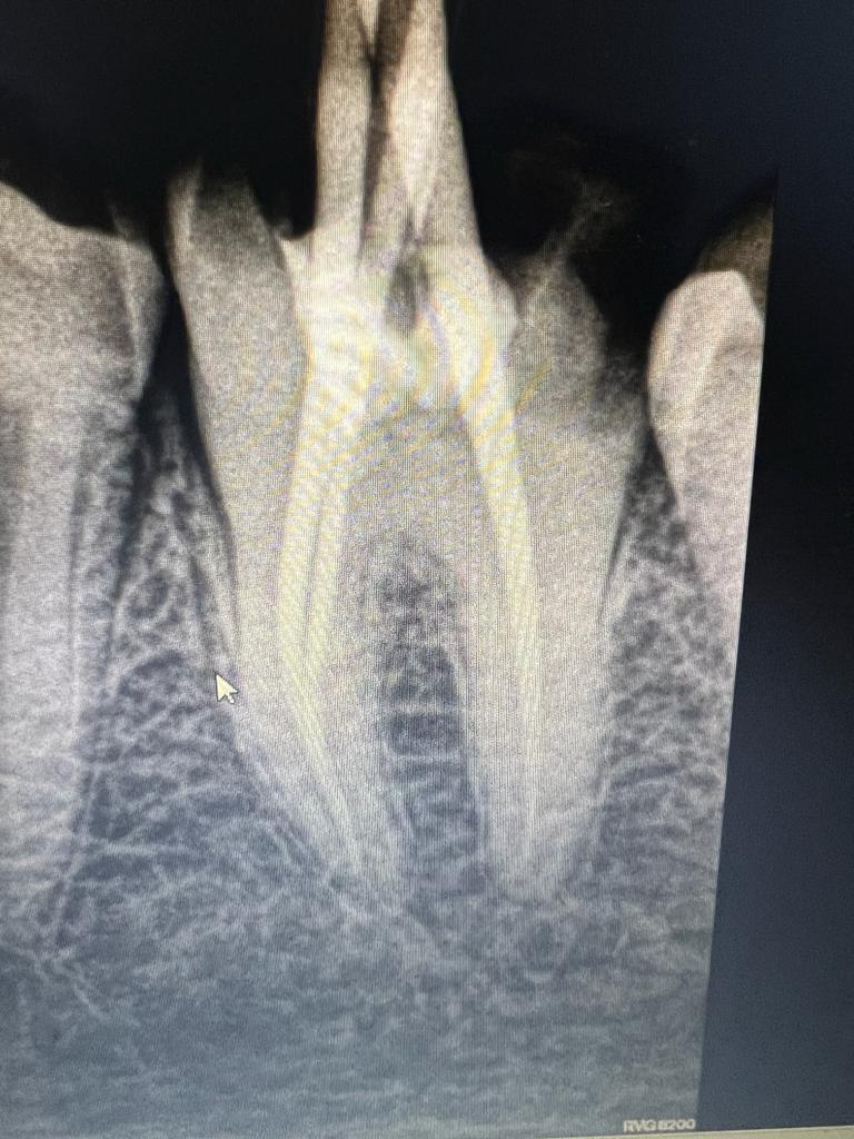 Root Canal Treatment scan