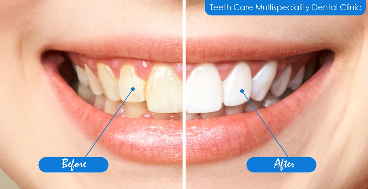 before after teeth whitening treatment in kolkata